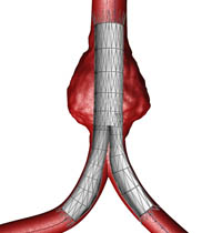 Abdominal Aortic Aneurysm Repair