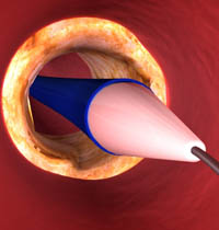 Carotid Artery Stenting